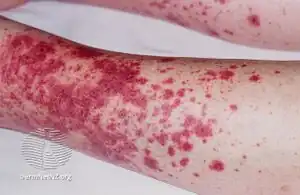 Palpable purpura
