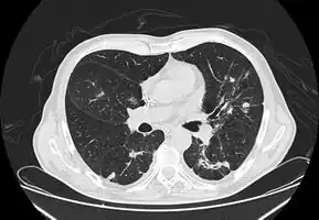 CT chest: Paracoccidioidomycosis