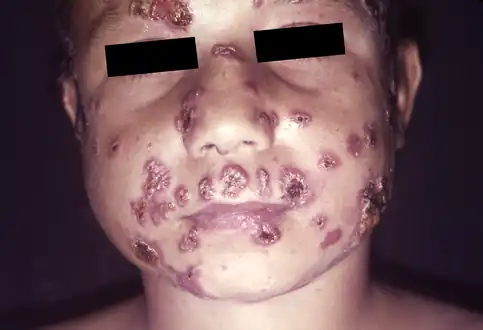 Lesions of paracoccidioidomycosis on a Brazilian child