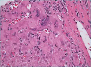 Giant cell transformation in autoimmune hepatitis
