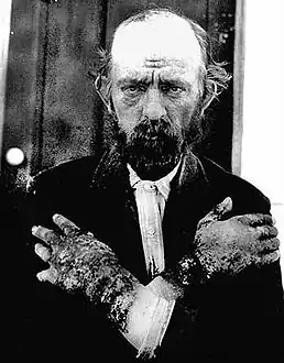 Person with pellagra with typical skin lesions