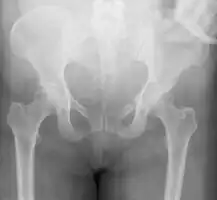Pelvic vertical shear fracture