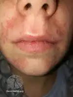 Perioral dermatitis