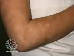 Pityriasis alba: light macules that merge