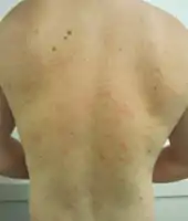 Pityriasis rosea on back
