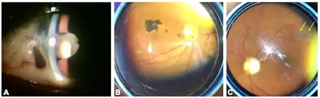a-c)Spectrum of ophthalmic findings in Lassa fever