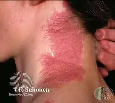 Port-wine stain