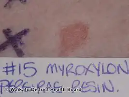 Positive patch test to fragrance