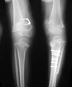 Pseudoachondroplasia. Leg radiographs depicting dysplastic distal femoral and proximal tibial epiphyses, and distal femoral metaphyseal broadening, cupping, irregularities (white arrows) and radiolucent areas especially medially. Note the metaphyseal line of ossification of the proximal tibias (blackarrows) and relative sparing of the tibial shafts. The  changes around the knee are known as "rachitic-like changes". Lesions are bilateral and symmetrical.