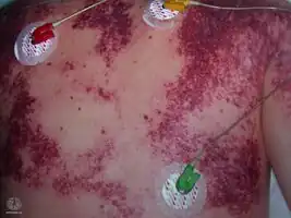 Purpura fulminans