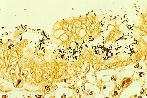 H.&nbsp;pylori colonized on the surface of regenerative epithelium (Warthin-Starry silver stain)
