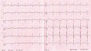 RBBB with associated first degree AV block