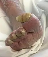 Onychogryphosis