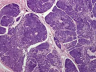 Dermal cylindroma. Hyaline droplets visible in lobules.
