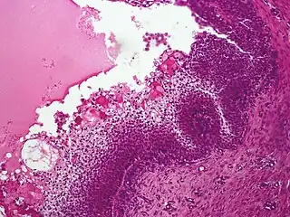 Acrospiroma, clear cell type