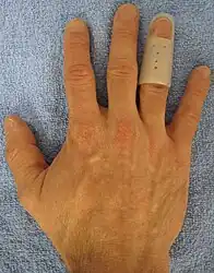 An example of a splint for mallet finger.