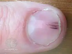Splinter hemorrhage