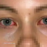 Stevens Johnson syndrome