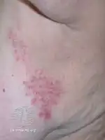 Subcorneal pustular dermatosis