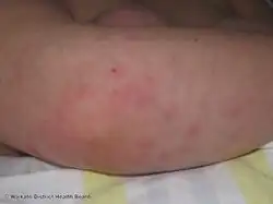 Sweet disease caused by vemurafenib