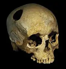 The perimeter of the hole in this trepanated Neolithic skull is rounded off by ingrowth of new bony tissue, indicating that the patient survived the operation.