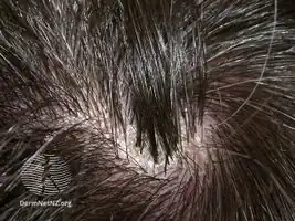 Tufted folliculitis