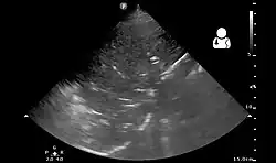 Pneumonia seen by ultrasound