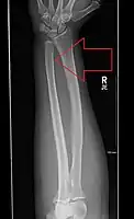 Updisplaced isolated ulna fracture