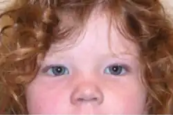 Epicanthal folds and increased distance between the eyes in 2-year-old girl with trisomy X