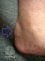 Cholesterol build up within the Achilles tendon