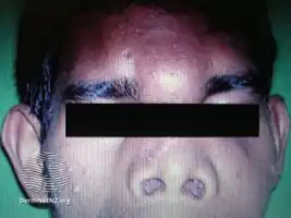 Mucormycosis of skin of forehead