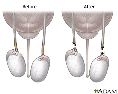 Before and after vasectomy Before and after vasectomy