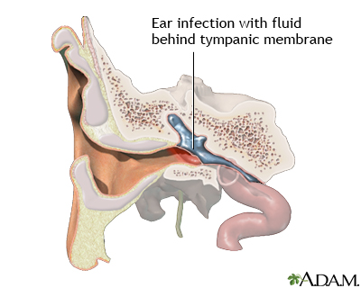 Indications Indications