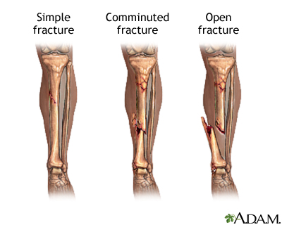 Bone fracture repair - series Bone fracture repair - series