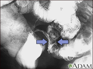 Crohn disease - X-ray Crohn disease - X-ray