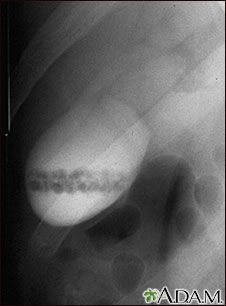 Gallstones, cholangiogram Gallstones, cholangiogram