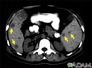 Spleen and liver metastases – CT scan Spleen and liver metastases – CT scan