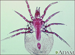Dust mite Dust mite