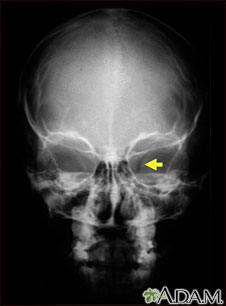 Neurofibromatosis I - enlarged optic foramen Neurofibromatosis I - enlarged optic foramen