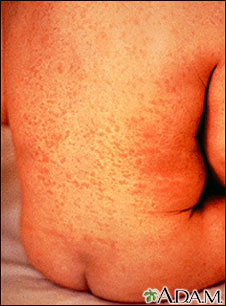 Rubella on an infant's back Rubella on an infant's back