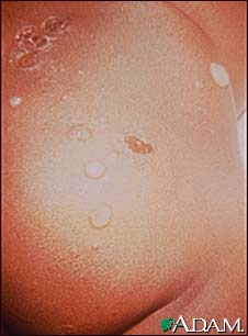 Impetigo - bullous on the buttocks Impetigo - bullous on the buttocks