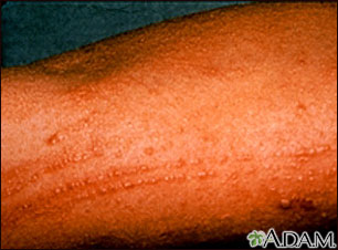 Poison oak rash on the arm Poison oak rash on the arm