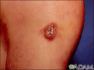 Kaposi sarcoma - lesion on the foot Kaposi sarcoma - lesion on the foot