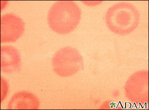 Red blood cells, target cells Red blood cells, target cells