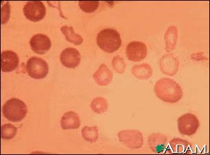 Thalassemia major Thalassemia major