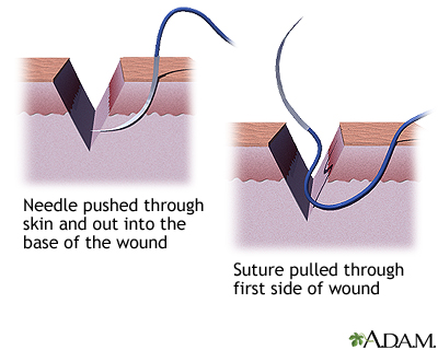 Sewing a wound closed, part 2 Sewing a wound closed, part 2