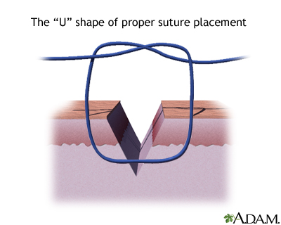 Sewing a wound closed, part 4 Sewing a wound closed, part 4