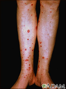 Henoch-Schonlein purpura on the lower legs Henoch-Schonlein purpura on the lower legs