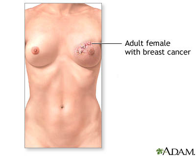 Breast reconstruction - series - Indication, part 1 Breast reconstruction - series - Indication, part 1