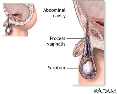 Hydrocele repair - series